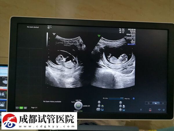 試管嬰兒懷雙胞胎同樣有風(fēng)險(xiǎn)，五大危害已羅列在此！(圖1)